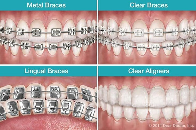 How Kids Are Afraid of Early Braces Implants and Smile Correction